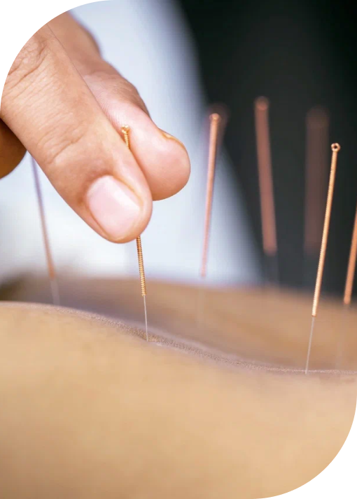 Acupuntura